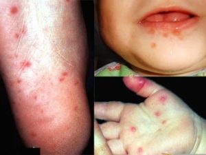 Coxsackie-virus-kéz-láb-száj betegség szindroma